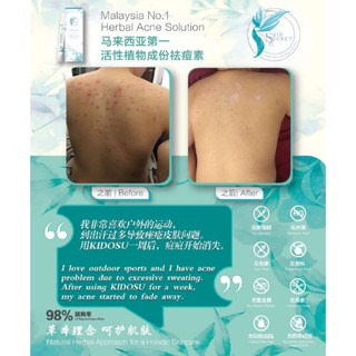 祛痘素 KIDOSU Herbal ACNE PimpleCream/ubat Jerawat/痘痘霜🎁Free 