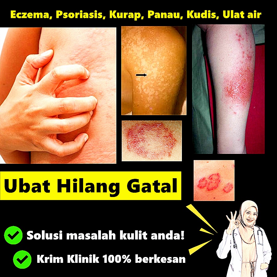 Krim Gatal Ubat Penghapus Gatal Dari Klinik Kulit Kurap Ekzima Kudis Panau Parasit Allergik Eczema Berkesan Hilang Gatal Shopee Malaysia