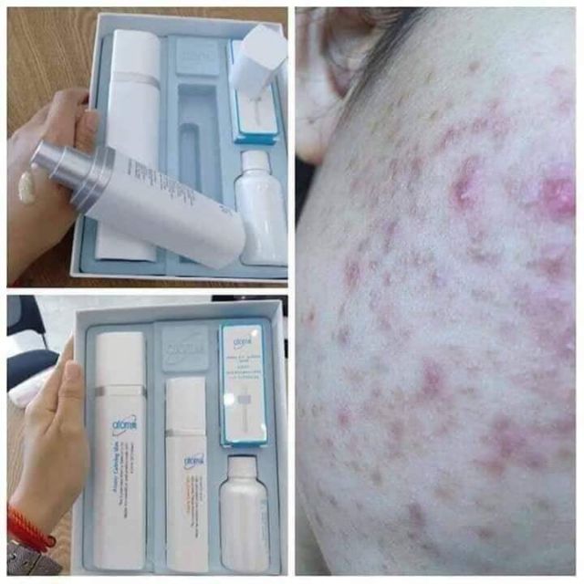 atomy product for pimples