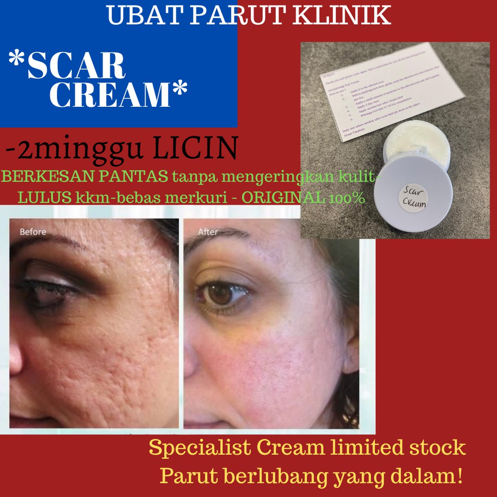 Scar Cream Klinik Kulit Skincare Original Berlubang Parut hitam 