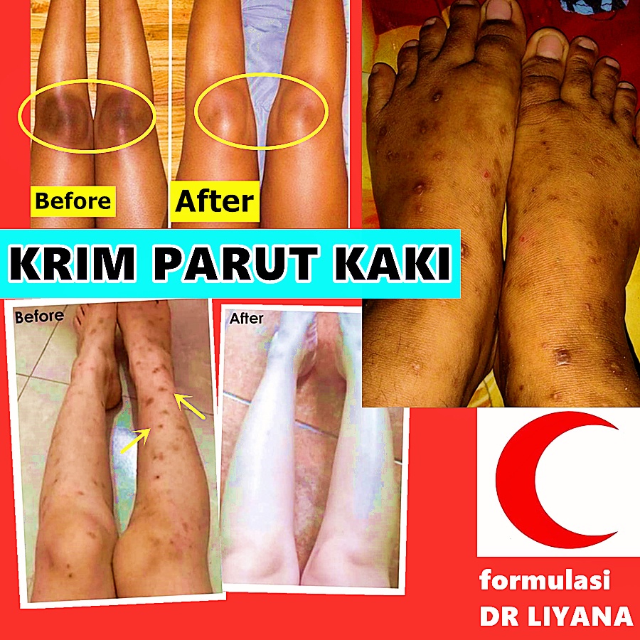 Krim Parut Kaki Leg Scar Krim Parut Kudis Kurap Parut Ekzema Parut Hitam Parut Gelap Parut Gatal Scar Bedbug Bite Shopee Malaysia