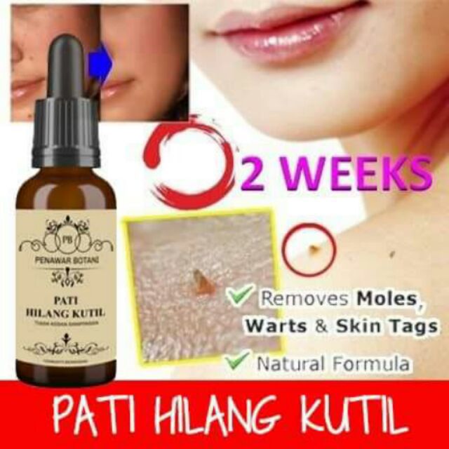 Ubat buka ketuat/kuntil/wart/biji kolestrol free gift 