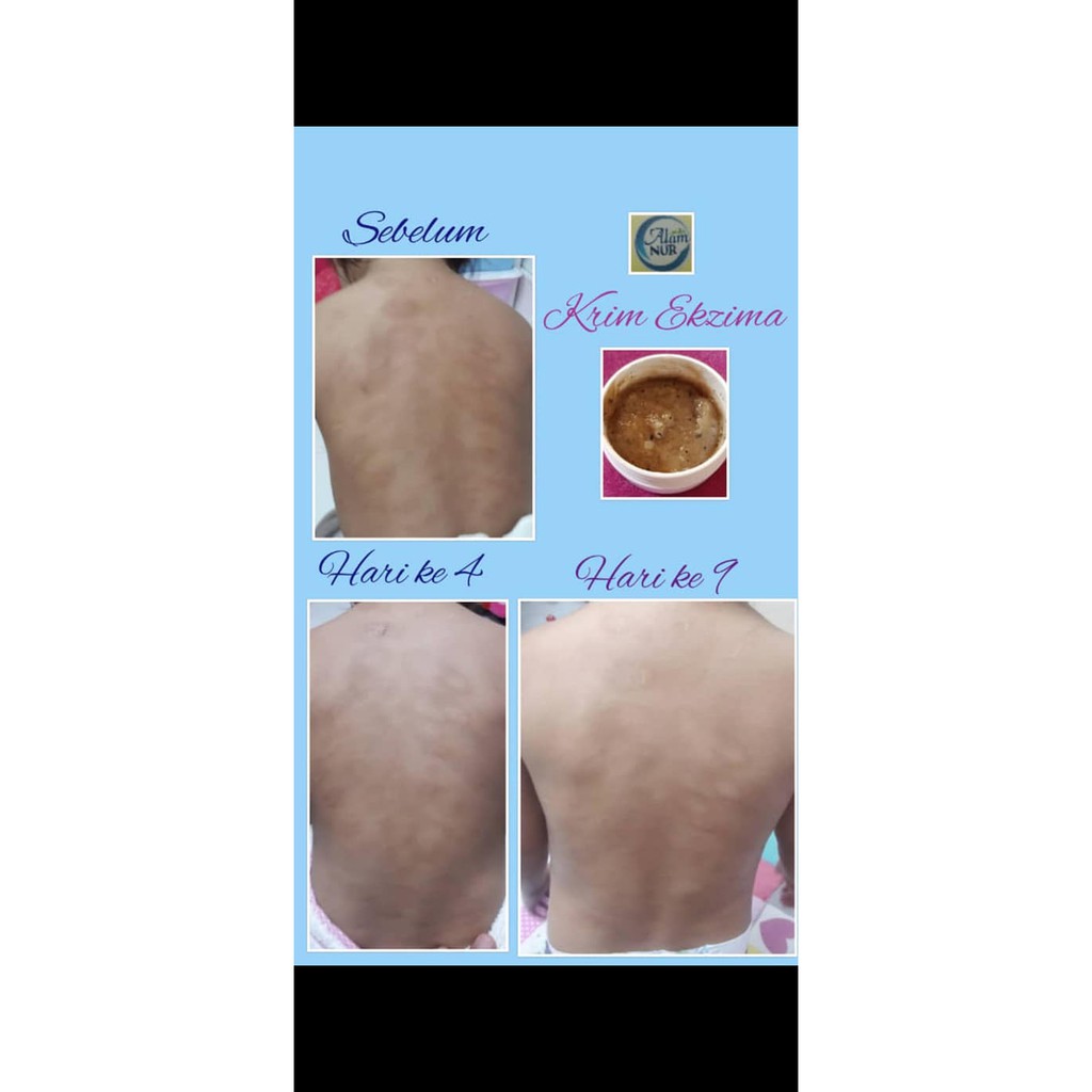 Buy Hq Ekzema Ubat Gatal Kudis Panau Kurap Ruam Alergik Psoriasis Krim Argan Alam Nur 20ml Ready Stock Seetracker Malaysia