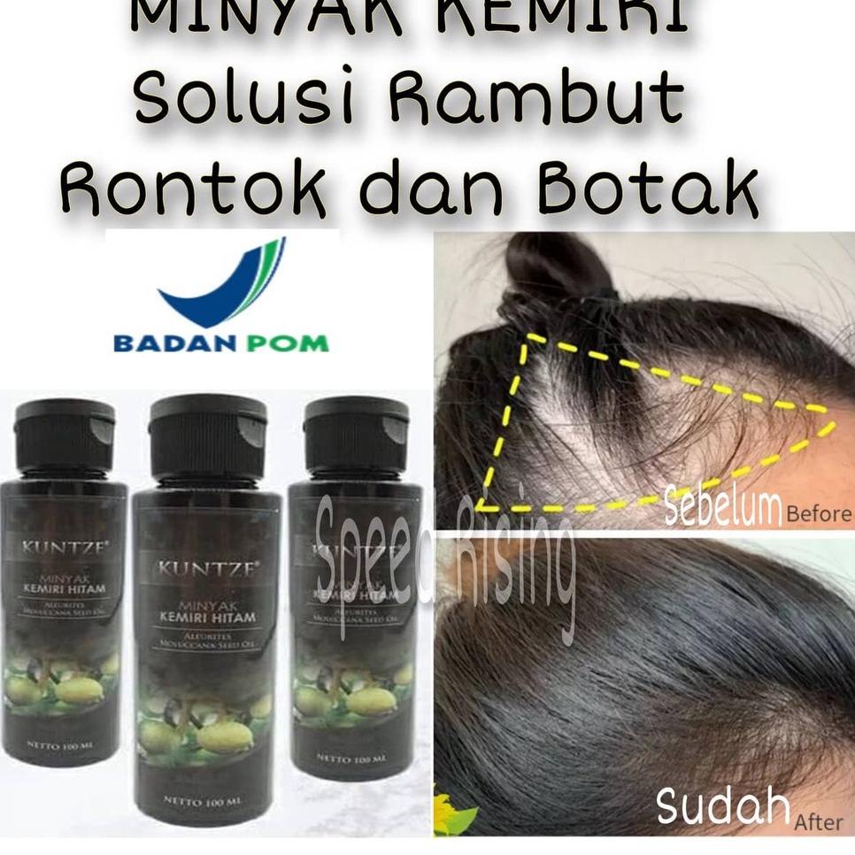 Candlenut Oil Hair Growth Bald Oil Candlenut Oil Kuntze BPOM Original
