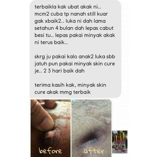 UBAT KURAP KAYAP RUAM KUDIS BISUL ECZEMA SENSITIVE SKIN 