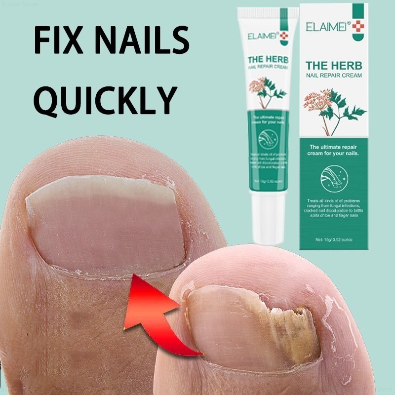 Fix Bad Nails Quickly Inhibit Nail Fungal Infection Remove Paronychia