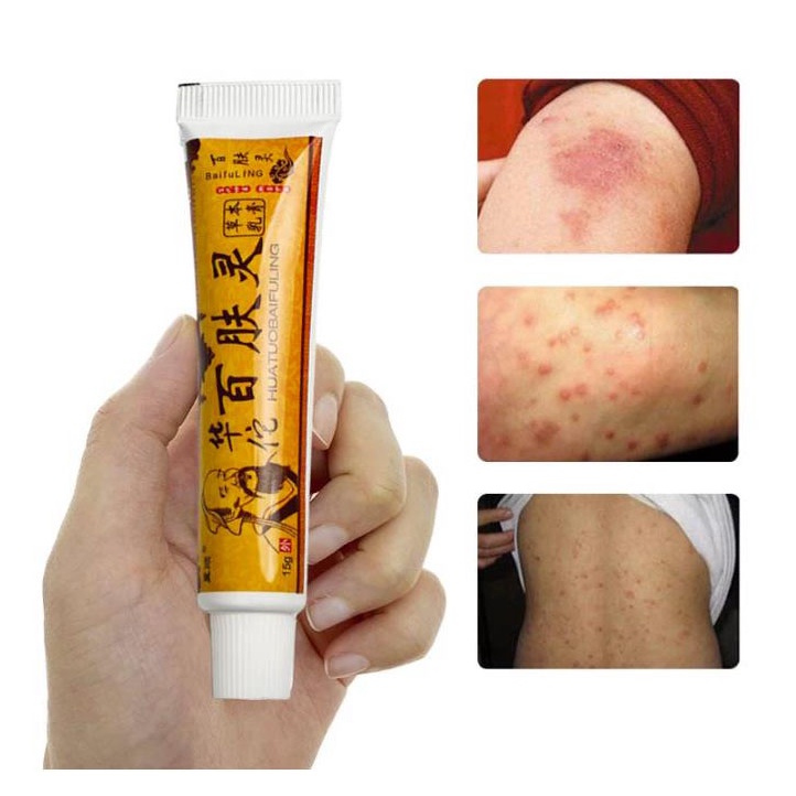 Chinese Herbal Eczema Creamantifungal Skin Itch Remedyhua Tuo Baifuling Anti Itch Ointment 