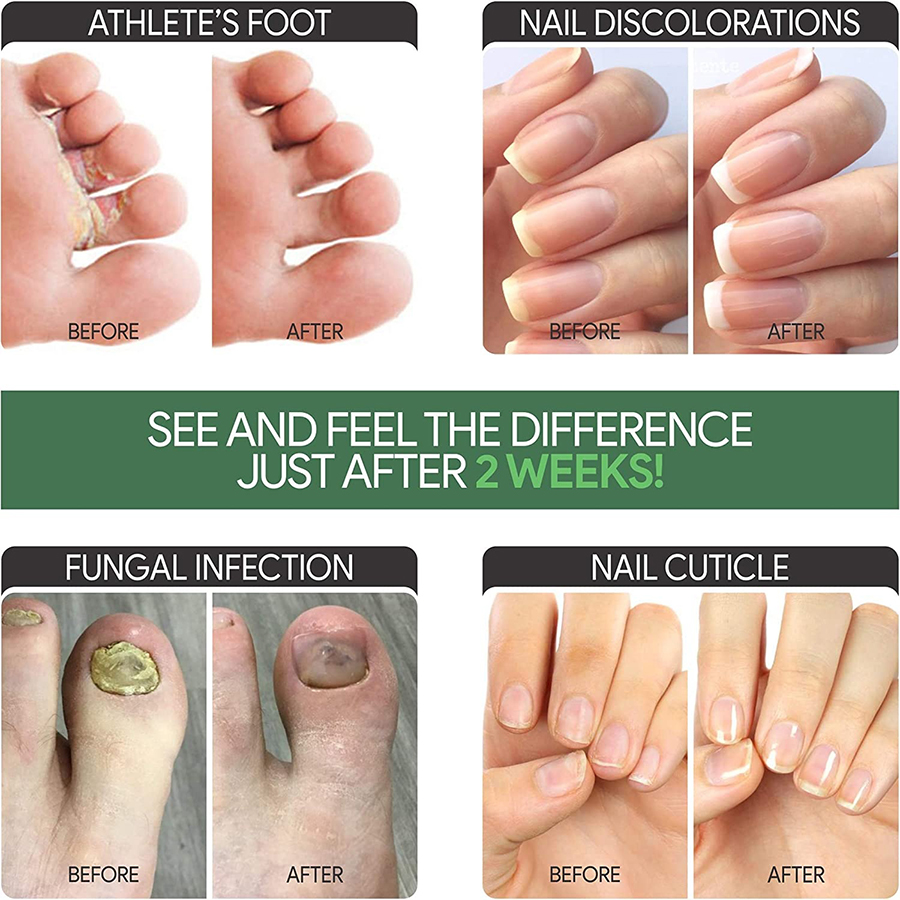 Essential Multi Get Healthy Fungus-Free Nails Our Extra-Strength Treatment: Repair Protect Prevent Fungal Infections - Image 3