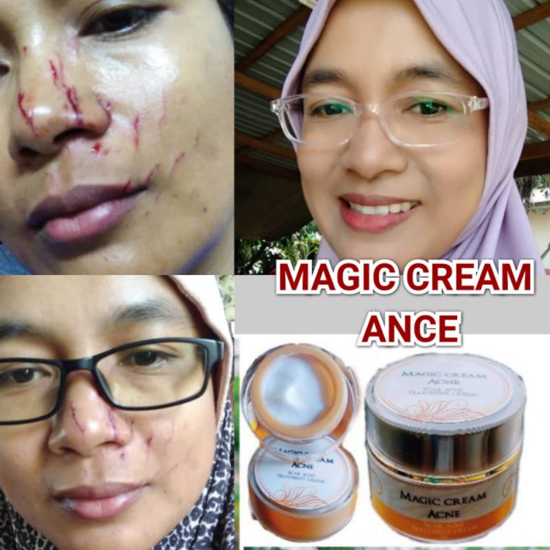 krim parut magic cream scar ance Original Shopee Malaysia
