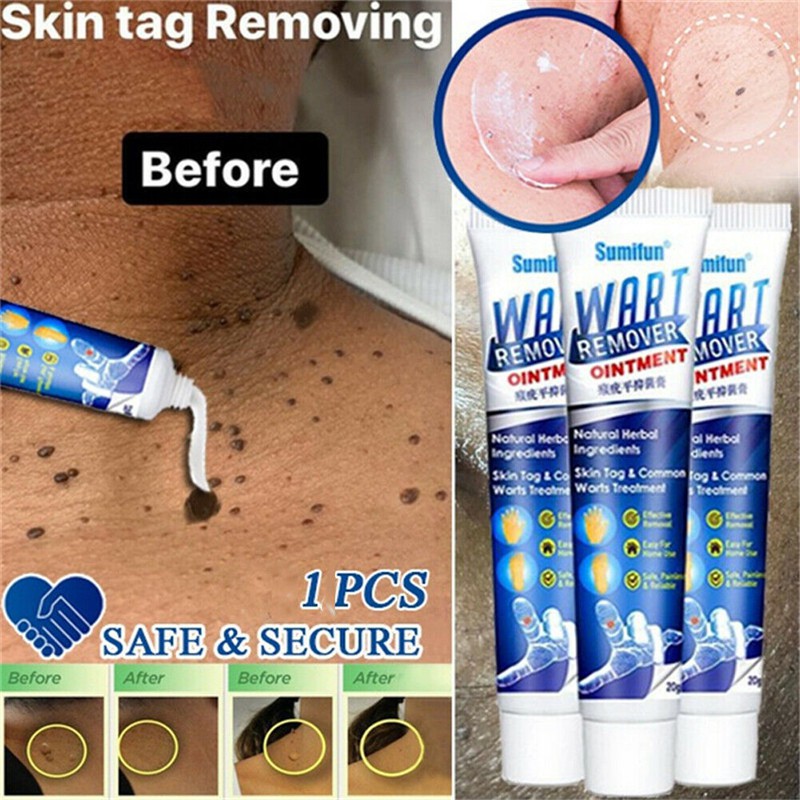 Wart Removal Ointment Fast Remove Skin Tag Remover Original Ointment Against Mole Genital Wart