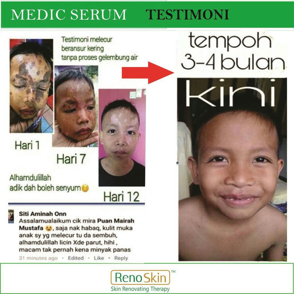 Serum Ubat Burn Skin Sensitive Skin Type Masalah Kulit Melecur Terbakar Luka Ekzema Psoriasis Gatal Kerapu Shopee Malaysia