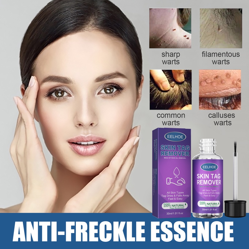 Skin Tag Remover Cream Genital Warts Treatment Dark Spots Freckle Moles