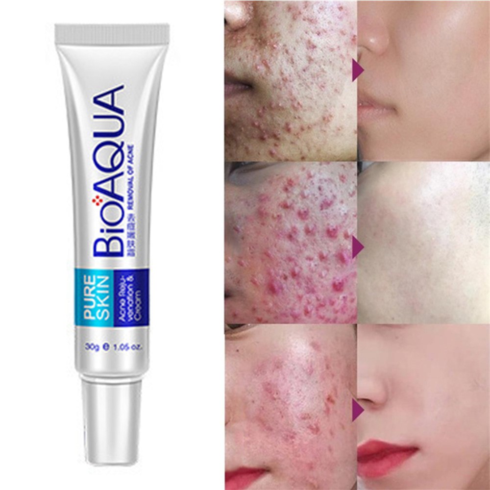 bioaqua face care anti acne pimples cream acne scar removal