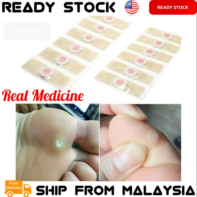 JIYANTIE Paste Foot Corn Plasters [ Remove The Corns ] Paste Clavus ...