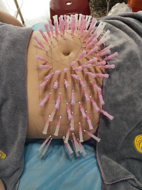 Single point point implant thread