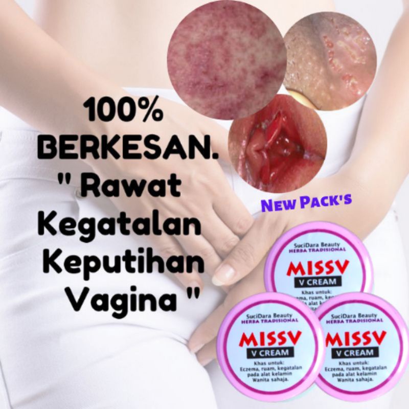 Promo Limited Ubat Keputihan Gatal Celah Peha Krim Gatal Kemaluan Anti Bakteria Rawat Gatal Gatal Keputihan Shopee Malaysia