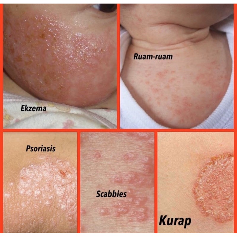 Ubat Kurap Mujarab Ubat Gatal Ekzema Krim Psoriasis Ubat Eczema Shopee Malaysia