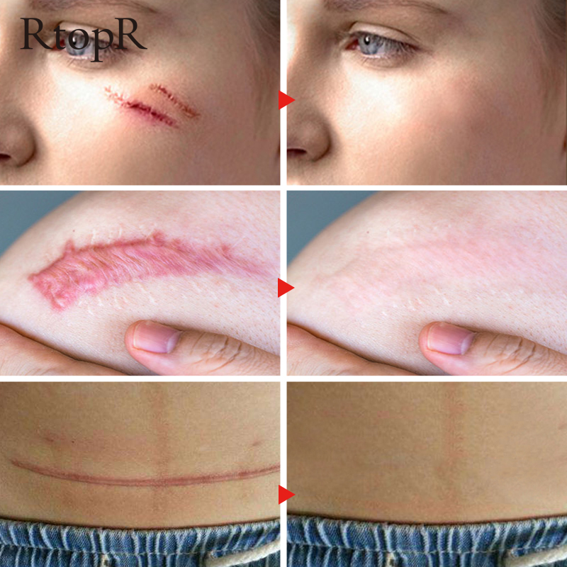 rtopr repair remove scar cream