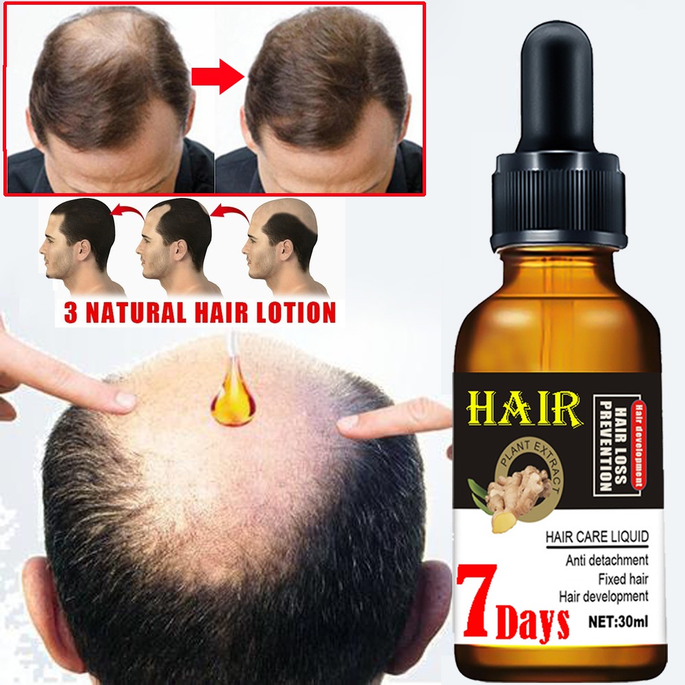 Ginger Hair Growth Oil 7 Days Fast Hair Growth Essence Hair Anti-loss Hair  Scaple Treatment | Shopee Malaysia