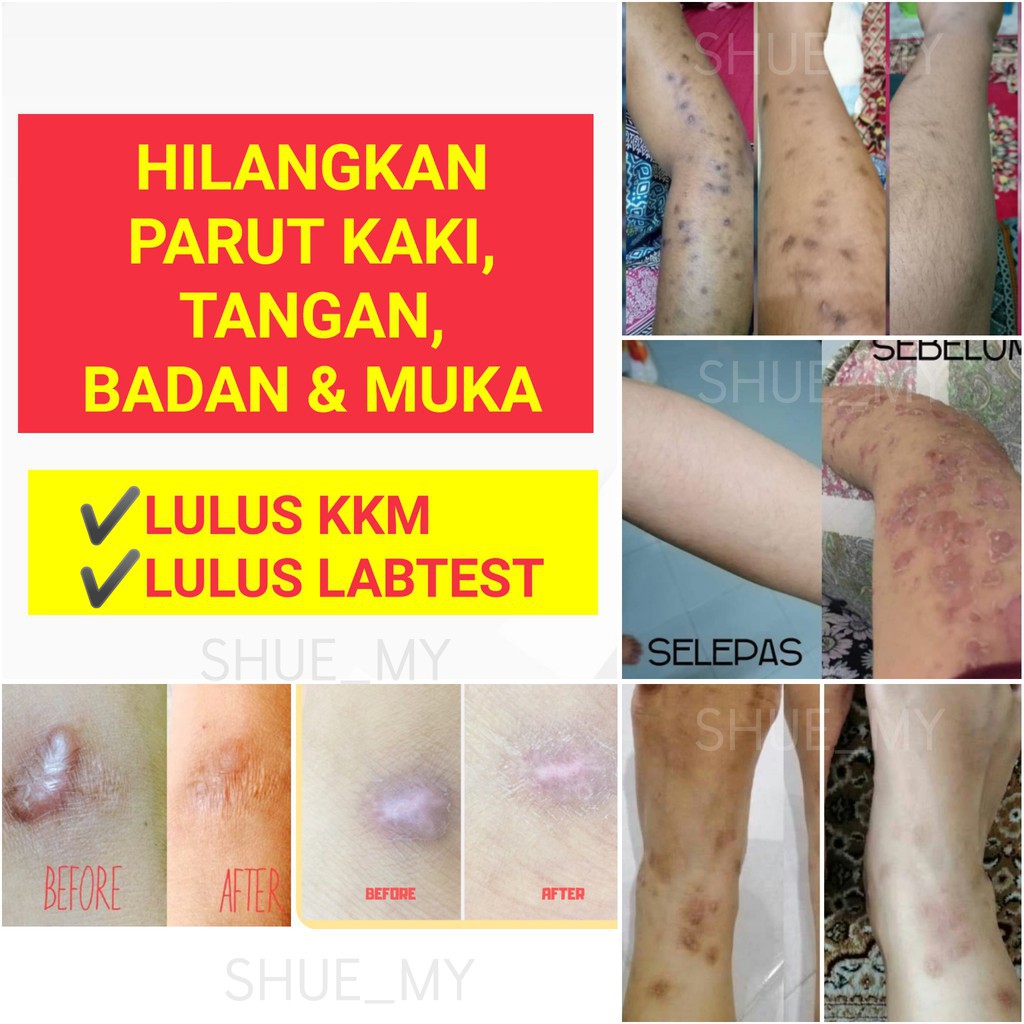 Macam Mana Nak Hilangkan Parut Kaki