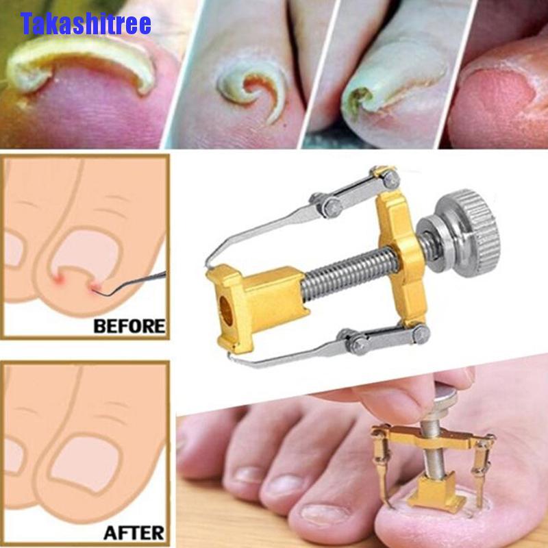 Craft Build Takashitree Ingrown Toenail Toe Fixer Recover Correction Device Pedicure Foot Nail Care Tool Repair Duty - Image 3