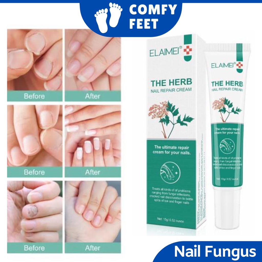 15G Nail Repair Cream Nails Fungus Gel Treatment For Remove Onychomycosis  Protects From Discoloration New | 15g Nail Repair Cream Nails Fungus Gel  Treatment For Remove Onychomycosis Protect From Discoloration 