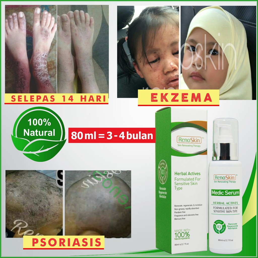 Natural Serum (Ubat, Krim) Merawat, Penawar Ekzema, Psoriasis, Masalah