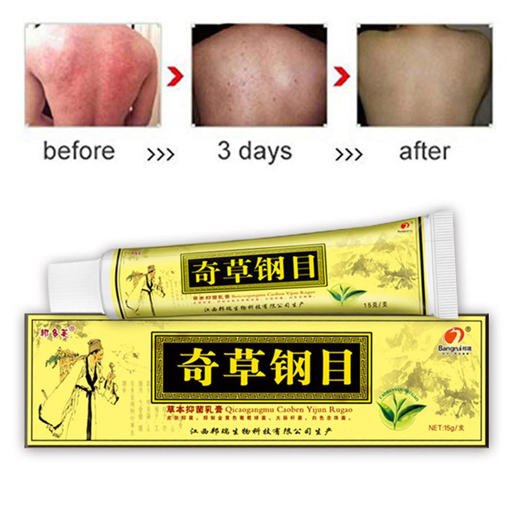 Chinese Herbal Eczema Psoriasis Creams Dermatitis Eczema Pruritus