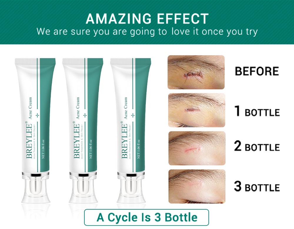BREYLEE Scar Removal Cream Treatment Remove Stretch Marks Whitening Cream (30g) Shopee Malaysia