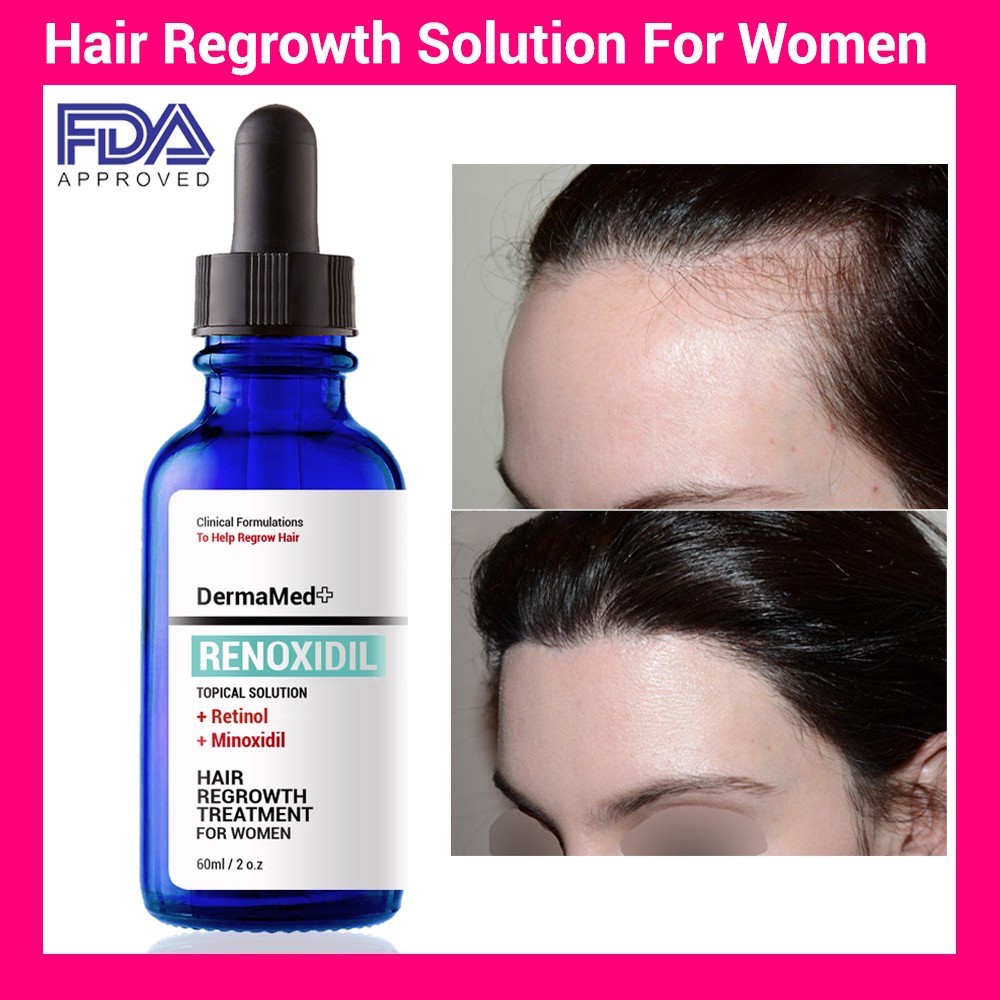 hair loss treatment malaysia