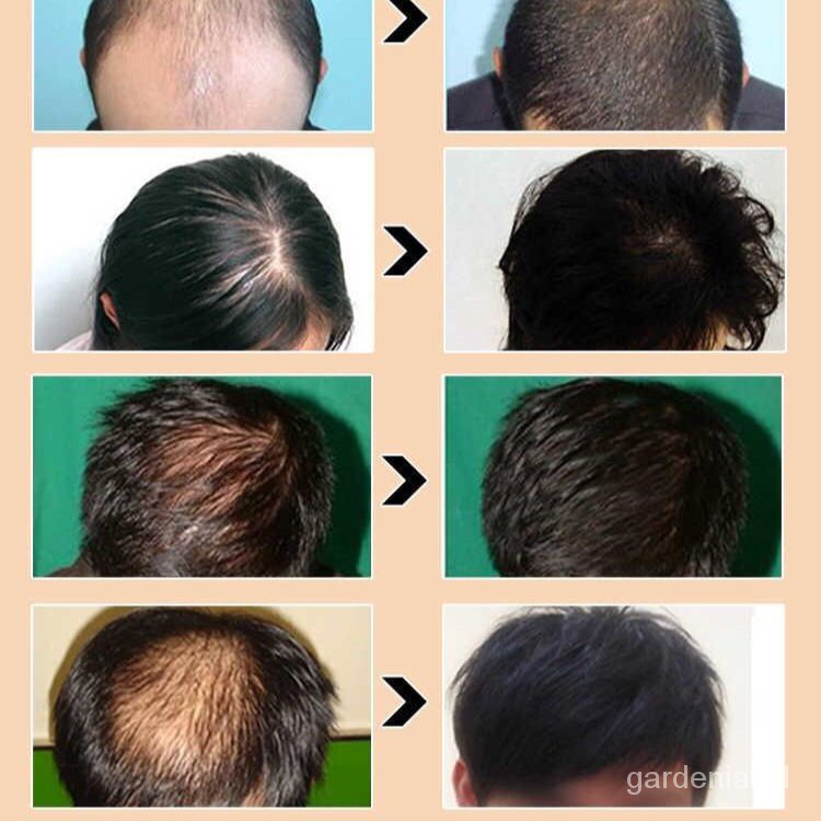 Hair care Prevent hair lossNine-Knot Grass Ginger Shampoo Anti Hair Loss Increase  Hair Density Mature Ginger Shampoo O | Shopee Malaysia