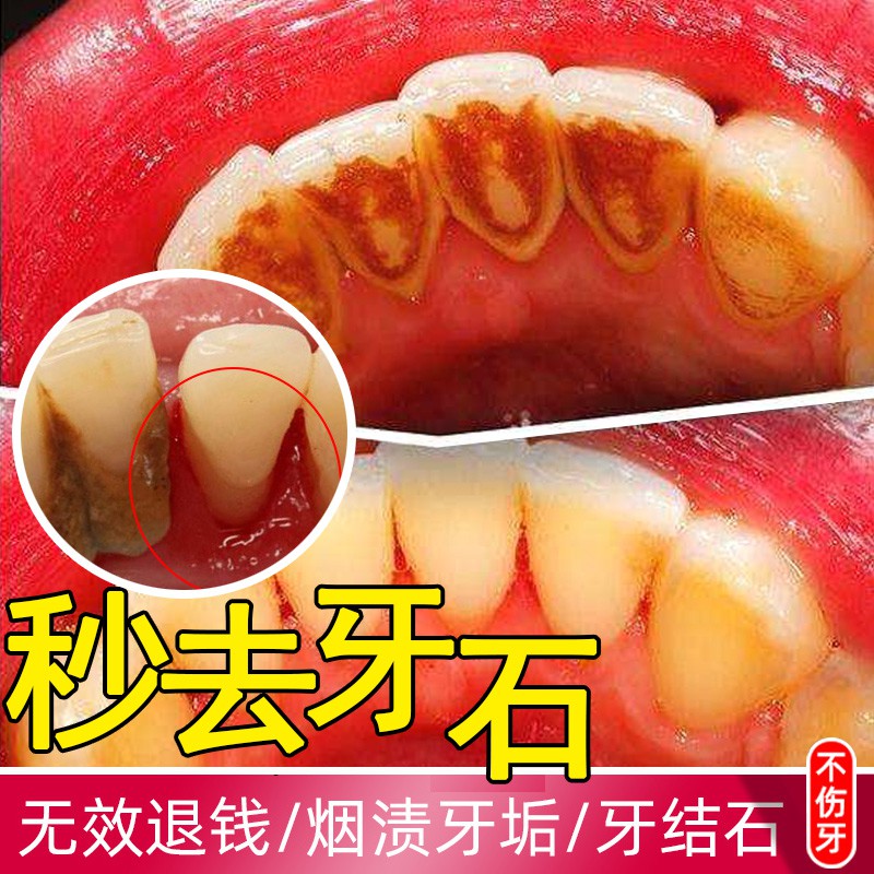 Buy 牙菌斑去牙垢牙结石去除器溶解牙石洗牙器液牙齿清洁清除神器速效 Seetracker Malaysia