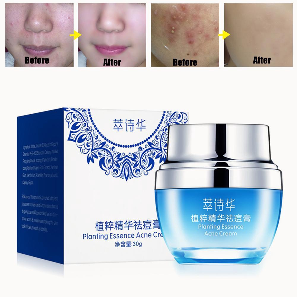 pigmentation & acne scar removal cream