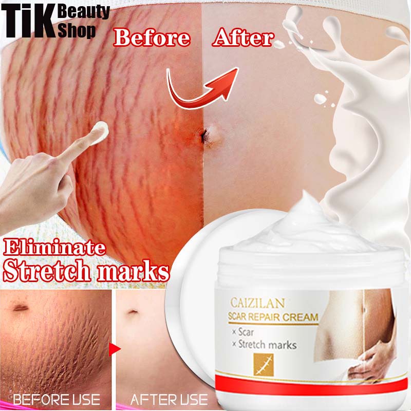 Original 30g Pregnancy Repair Cream Stretch Mark Removal Cream Removal Acne Scar Stretch Marks
