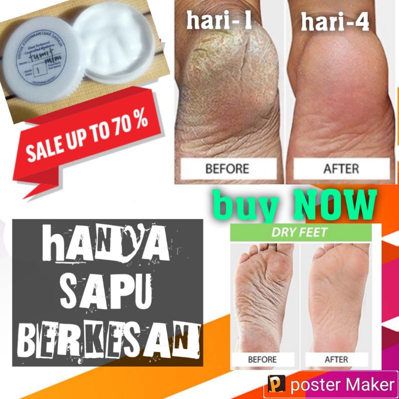 Rawatan Tumit Merekah Dengan Minyak Kelapa Dan Gula: Cara Mudah Dan Berkemampuan