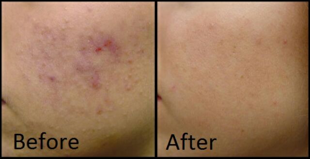 katialis cream for pimples