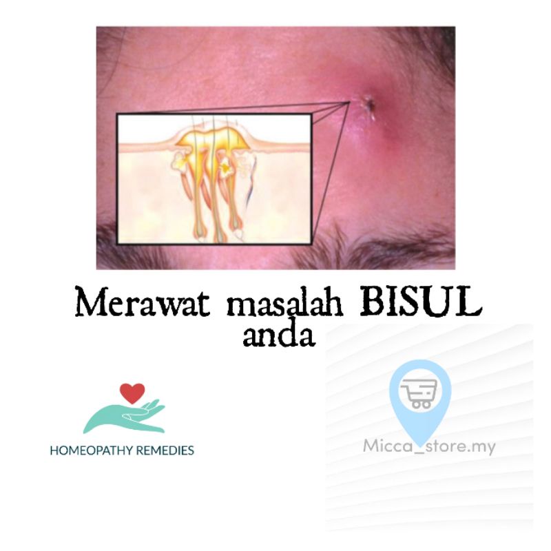 Merawat Bisul Homeopathy Selamat Berkesan Sila Chat Details Masalah Penyakit Anda Shopee Malaysia