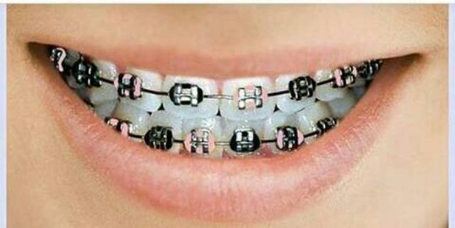 Braces Click Atas Saja Shopee Malaysia