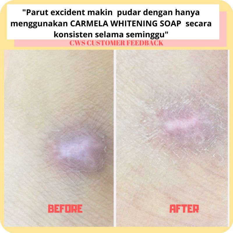 Hilangkan Parut Kaki Tangan Muka Dan Badan Shopee Malaysia