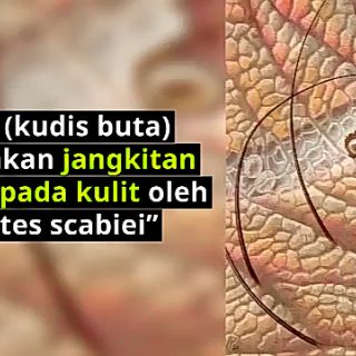 Permethrin ubat kutu Kudis buta scabies dan semua jenis 