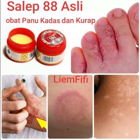 Salep 88 Isi 6 Gram Obat Gatal Panu Kadas Kurap Kutu Air Penyakit Kulit Ready Stock Malaysia Shopee Malaysia