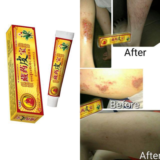 Eczema treatment Anti bacterial skin fungus cream 藏药皮宝 