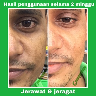 PIL JERAWAT & JERAGAT HOMEOPATHY MURAH 90 BIJI (single 
