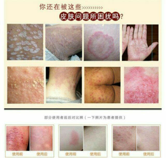 Ubat Psoriasis Ubat Gatal Ubat Eczema Ubat Kurap Ubat Herba Cina Shopee Malaysia