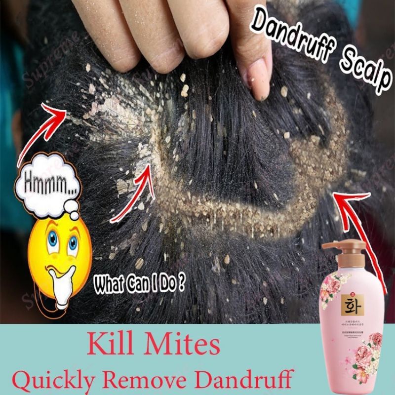 anti dandruff anti mites shampoo clean scalp itching improving hair ...