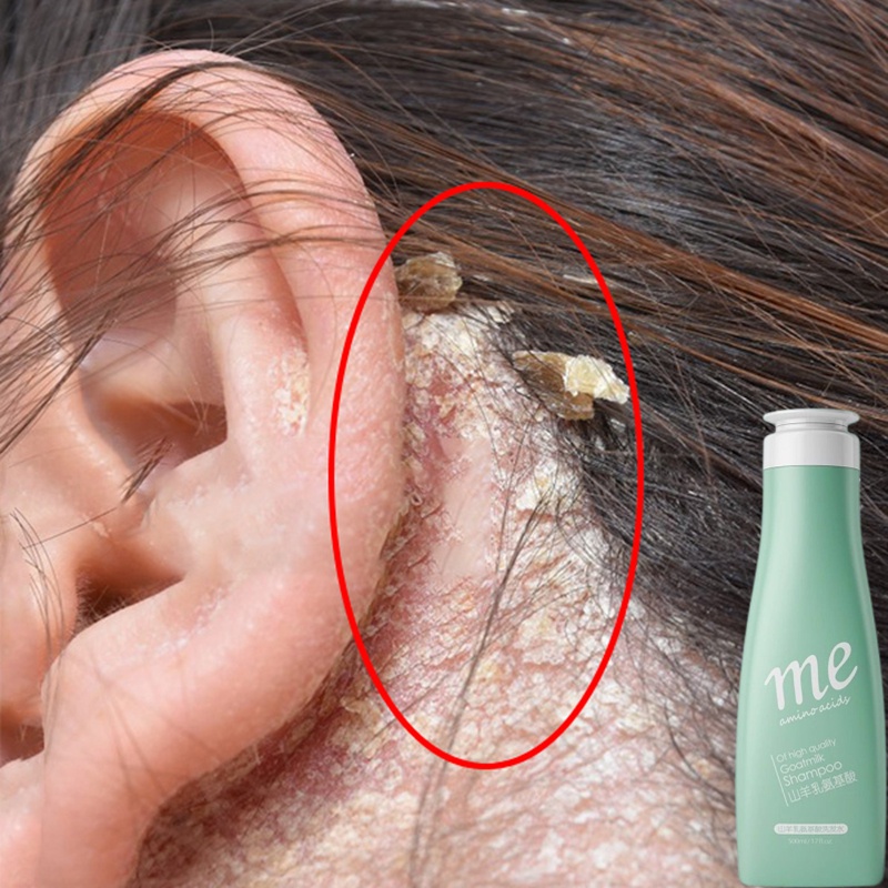 Shampoo kelemumur dandruff shampoo anti dandruff anti mites shampoo