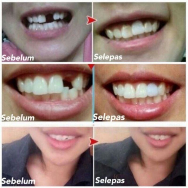 Promosi ready stock!! Diy Gigi Palsu 5 u0026 15 gram temporary teeth 