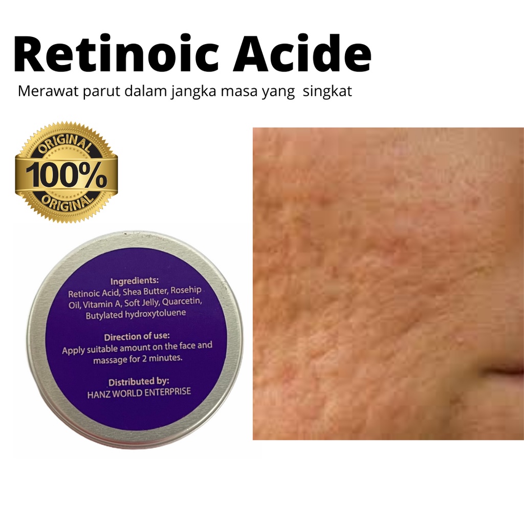 Krim Parut / Scar Cream Treatment / Pori / Parut Jerawat Kusam / Black Head Bintik Hitam / Ozza /10g / 20g