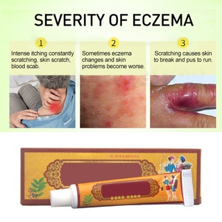 YWDH 1 Piece Treatment Dermatitis Eczema Hand Ringworm Antipruritic