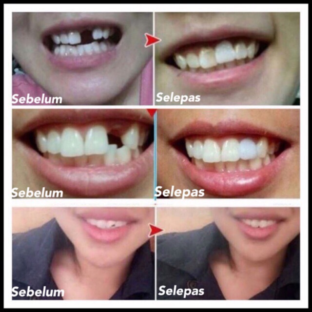 Gigi Palsu Original Solid Dentures Boleh Kunyah Makanan Tak Mudah Cabut Sesuai Untuk Semua Jenis Gigi Tahan 6 12bulan Shopee Malaysia